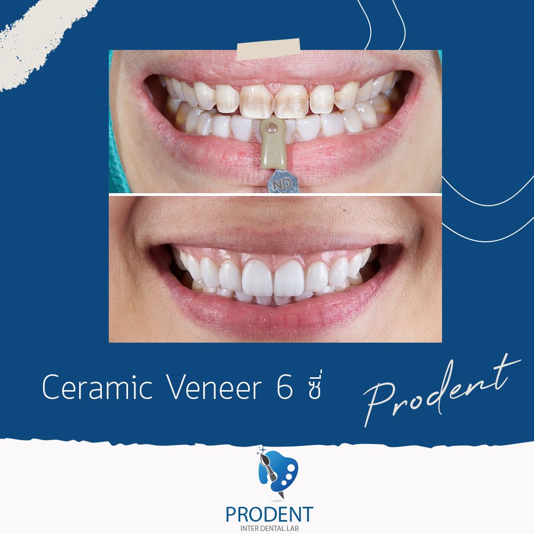 Ceramic Veneer