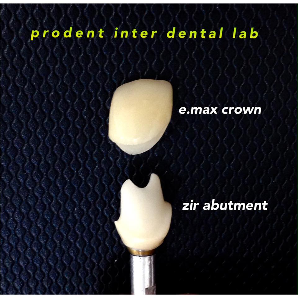 Crown over Implant